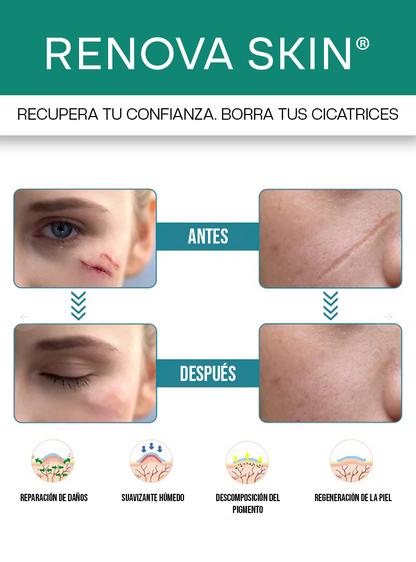 RENOVA SKIN® | CINTA DE SILICONA PARA QUITAR CICATRICES